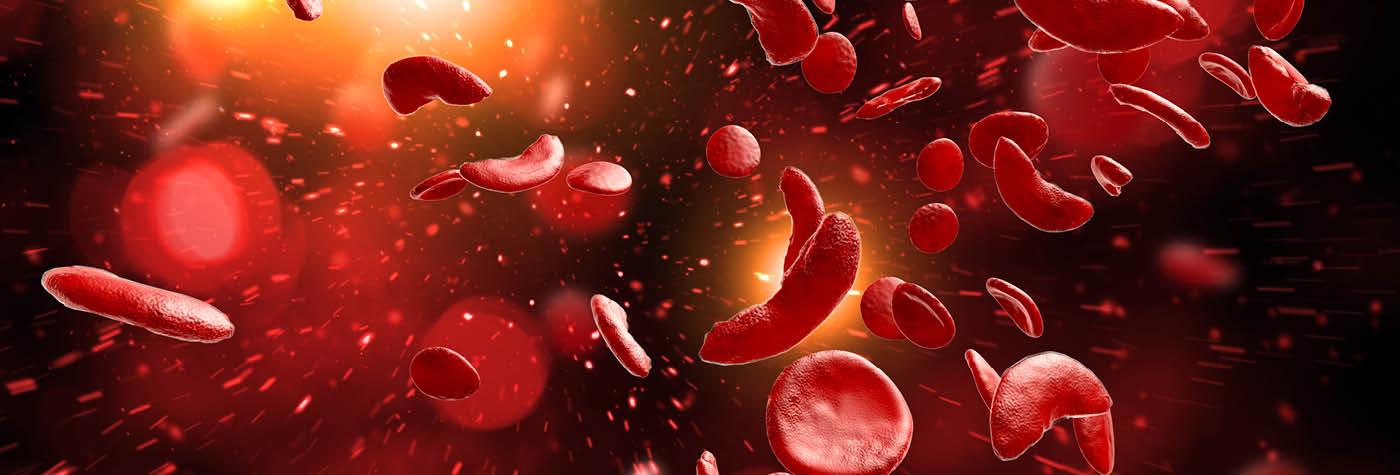 A magnified image of blood cells in someone with sickle cell.