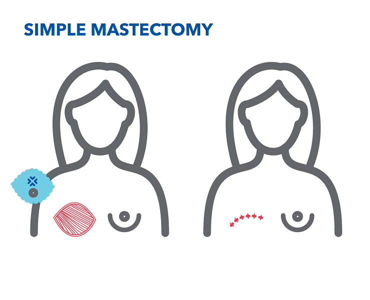 simple-mastectomy