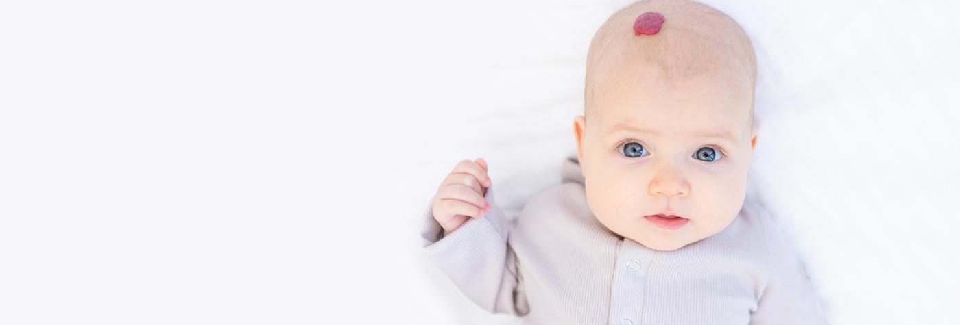 A baby with a red hemangioma on its head, wearing an off-white sweater and lying on a white background.