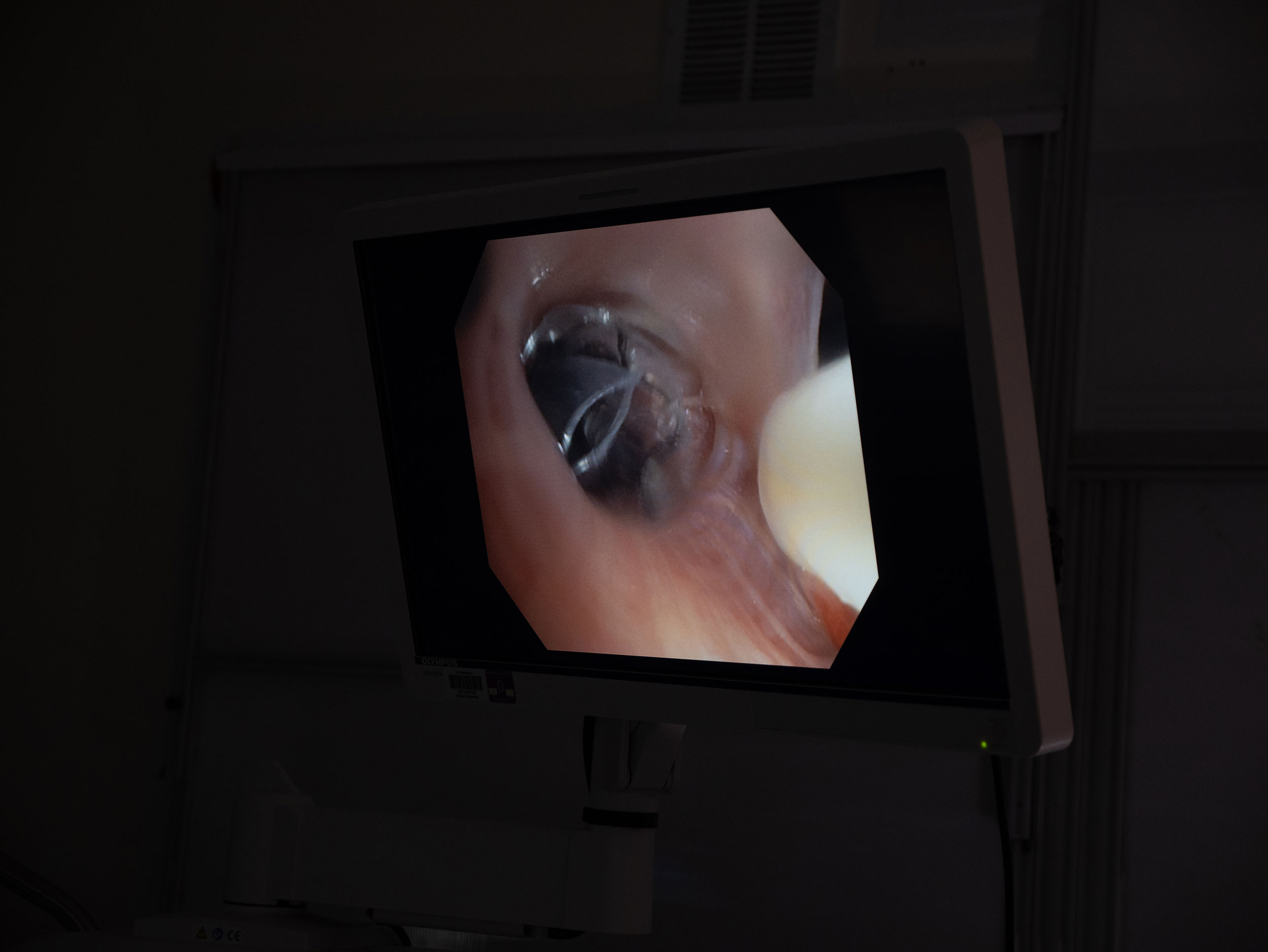 Placement of a Zephyr valve occurring inside a lung, as visibile on a computer monitor