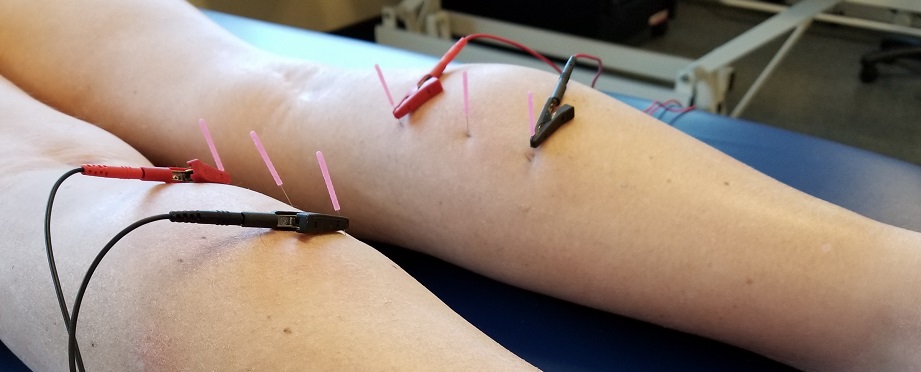 A patient undergoes a dry needling procedure on their calves.