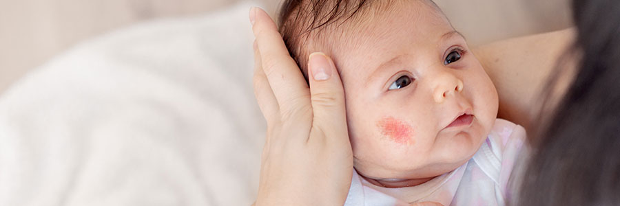 Baby with vascular birthmark