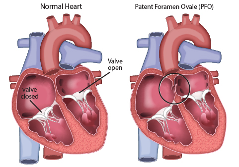 Patent Foramen Ovale UK Healthcare