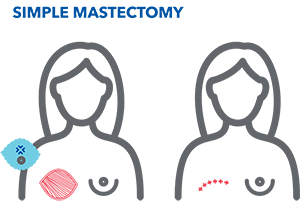 simple mastectomy