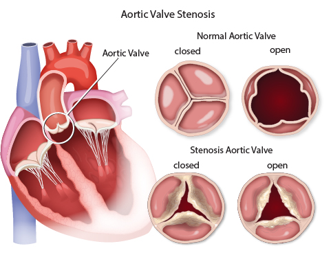 Aortic stenosis diagram