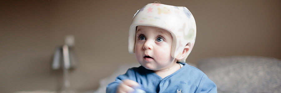 Baby with helment for Plagiocephaly