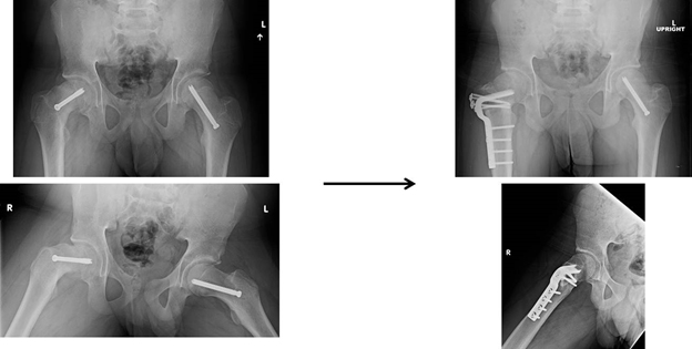 X-rays showing treatments for FAI.