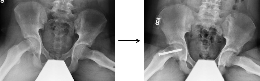X-rays showing in-situ pinning for slipped capital femoral epiphysis.