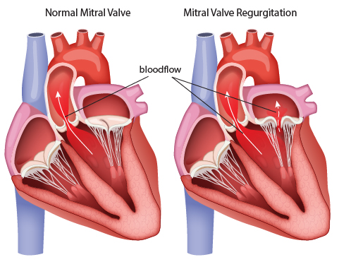 Mitral valve regurgitation diagram