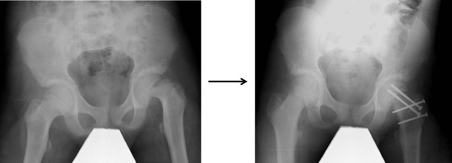X-rays showing open surgery for slipped capital femoral epiphysis.