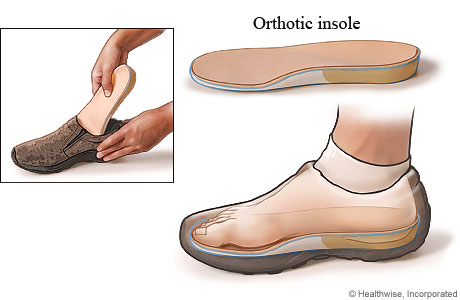 view of orthtotic insole