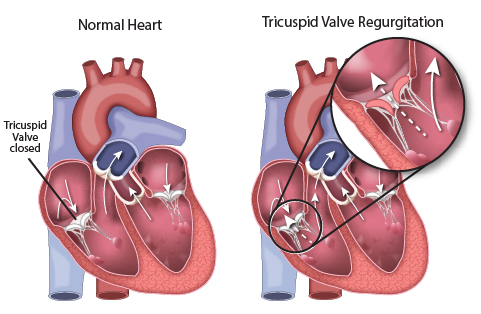 Tricuspid valve regurgitation diagram