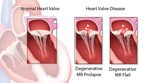 Valve disease diagram