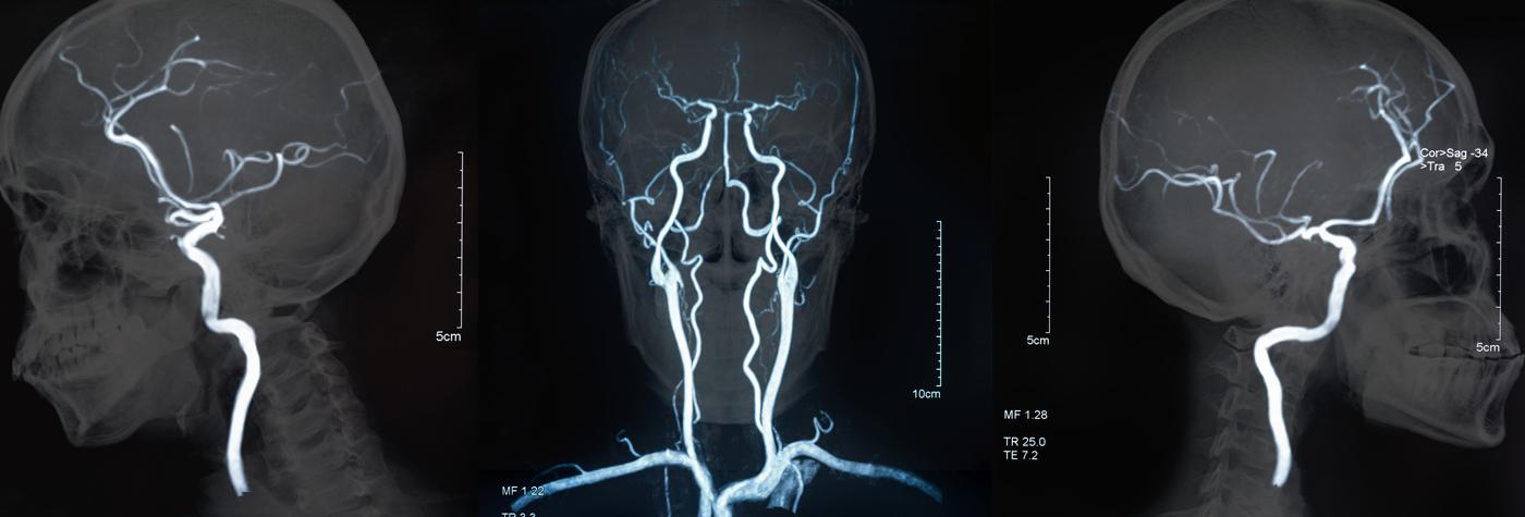 Three views of an skull X-ray.