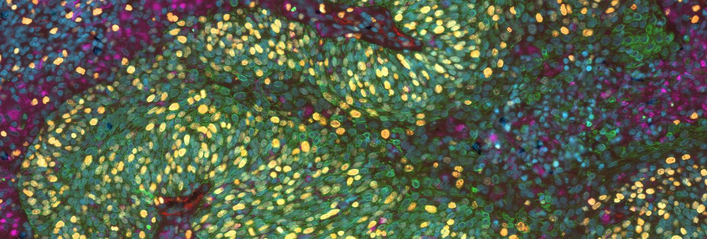 lunaphore cancer cell under microscope