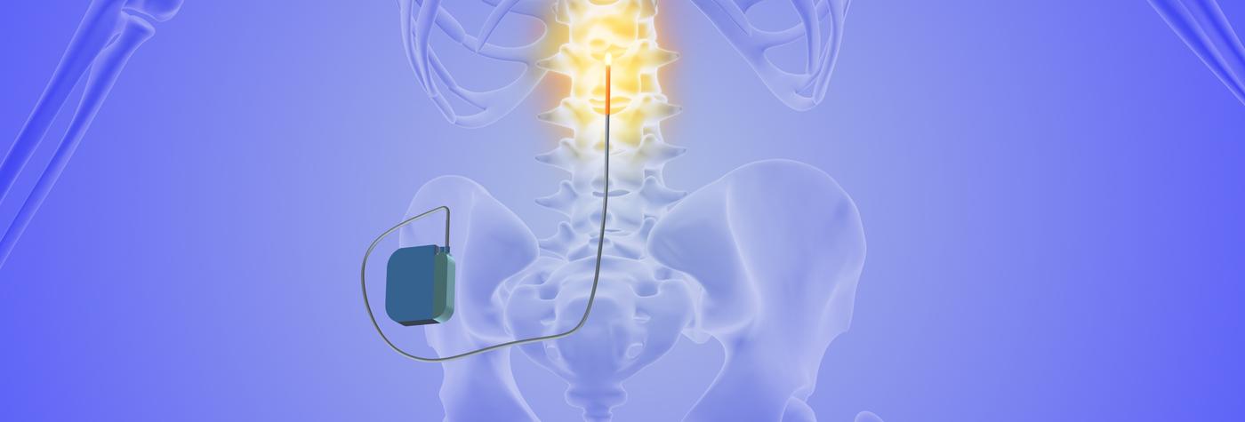 Illustration showing how neuromodulation therapy works.