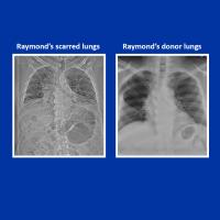 X-rays of Raymond Cloud's lungs before and after transplant surgery.