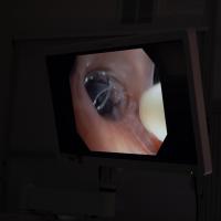 Placement of a Zephyr valve occurring inside a lung, as visibile on a computer monitor