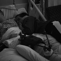Black and white photo of Caleb and Amelia sleeping in his hospital bed. Caleb's knee has an external fixator attached to stabilize it.