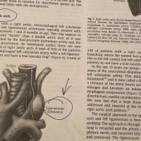 A close-up of a section of text in a printed-out cardiac seminar paper, describing the right aortic arch of the heart, with circled notes and arrows indicating specific places to note.
