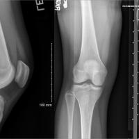 Three side-by-side X-rays of Mac’s knee, from the front, back, and side.