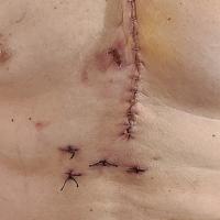 A close-up photo of the stitches and sutures in Andy’s chest following his surgery.